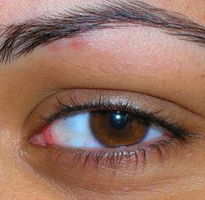 What are some causes of a twitching right eyelid?