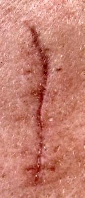 Facial scar removal