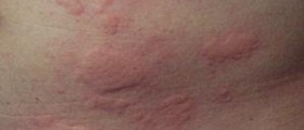 Facts on underarm rash