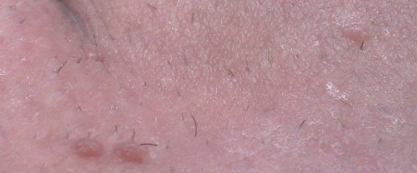 What Do Genital Warts Look Like? - verywell.com