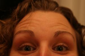 How to get rid of forehead wrinkles