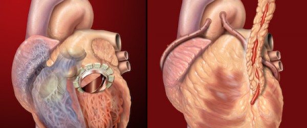 20 Week Ultrasound Heart Calcification Dietary