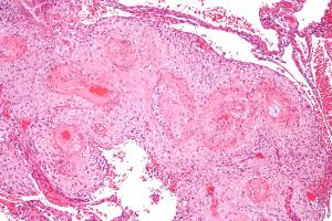 Hypertrophic cardiomyopathy information