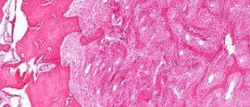 Idiopathic pulmonary fibrosis: Life expectancy and quality of life