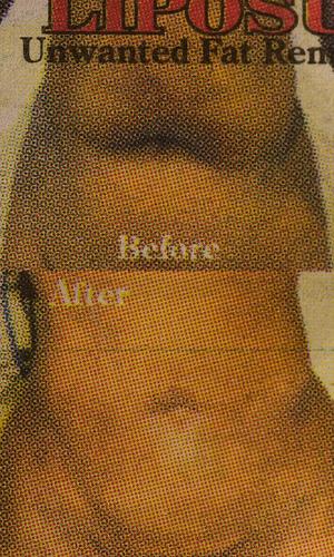 Information on liposuction procedures