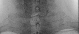 Is esophageal cancer on the rise