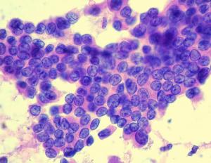 Is there a cure for underactive thyroid