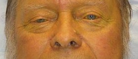 Jaundice in adults