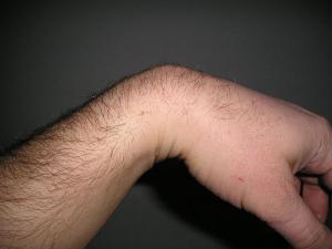 Left wrist pain