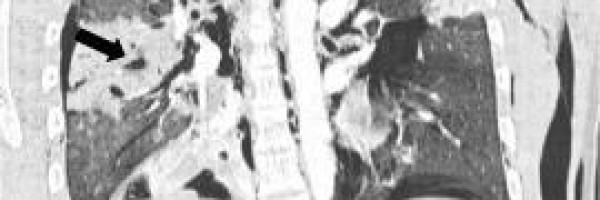 Lung diseases caused by smoking