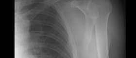 Manual therapy for frozen shoulder