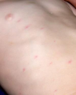 bupropion rash