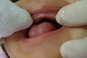Oral HCG facts