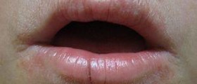 Perioral dermatitis cure