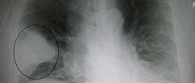 Pneumonic plague and bubonic plague