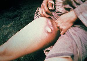 Prevention of bubonic plague