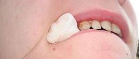 Prevention of dry socket
