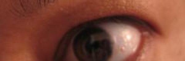 Prevention of eye strain