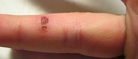 Prevention of fever blisters