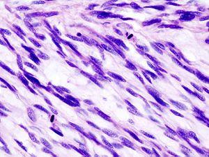 Prevention of fibroids