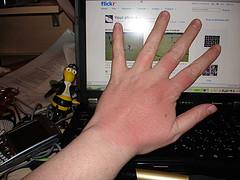 Prevention of liver spots
