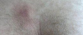 Prevention of pilonidal cysts
