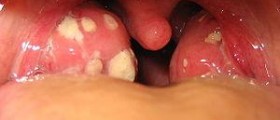 Prevention of quinsy