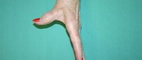 Prevention of RA