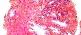 Prostate cancer survival