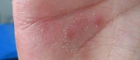 Rash on hands and feet