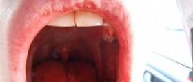 Recovery time after wisdom teeth removal