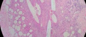 Recovery time for lumpectomy