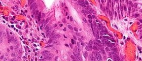 Regular cancer screening: Esophageal cancer survival