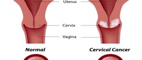 How Often Should I Get a Pap Test? New Guidelines for Cervical Cancer Screening
