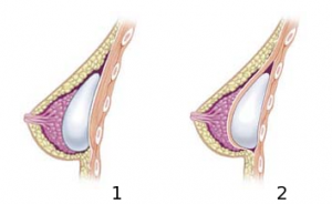 Silicone breast implants