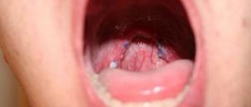 Sinus drainage in throat