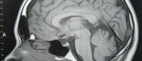 Sinus pain and pressure