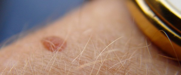 Painful mole diagnosis General center