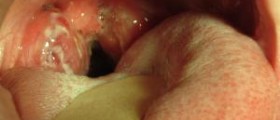 Strep throat incubation period