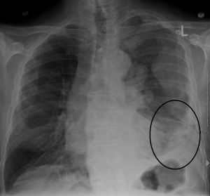 Symptoms of mesothelioma