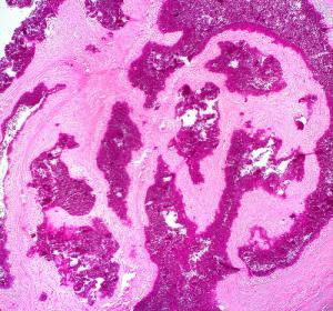 Symptoms of renal failure
