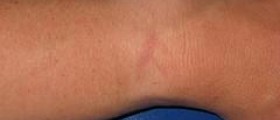 Therapy for tendonitis in wrist
