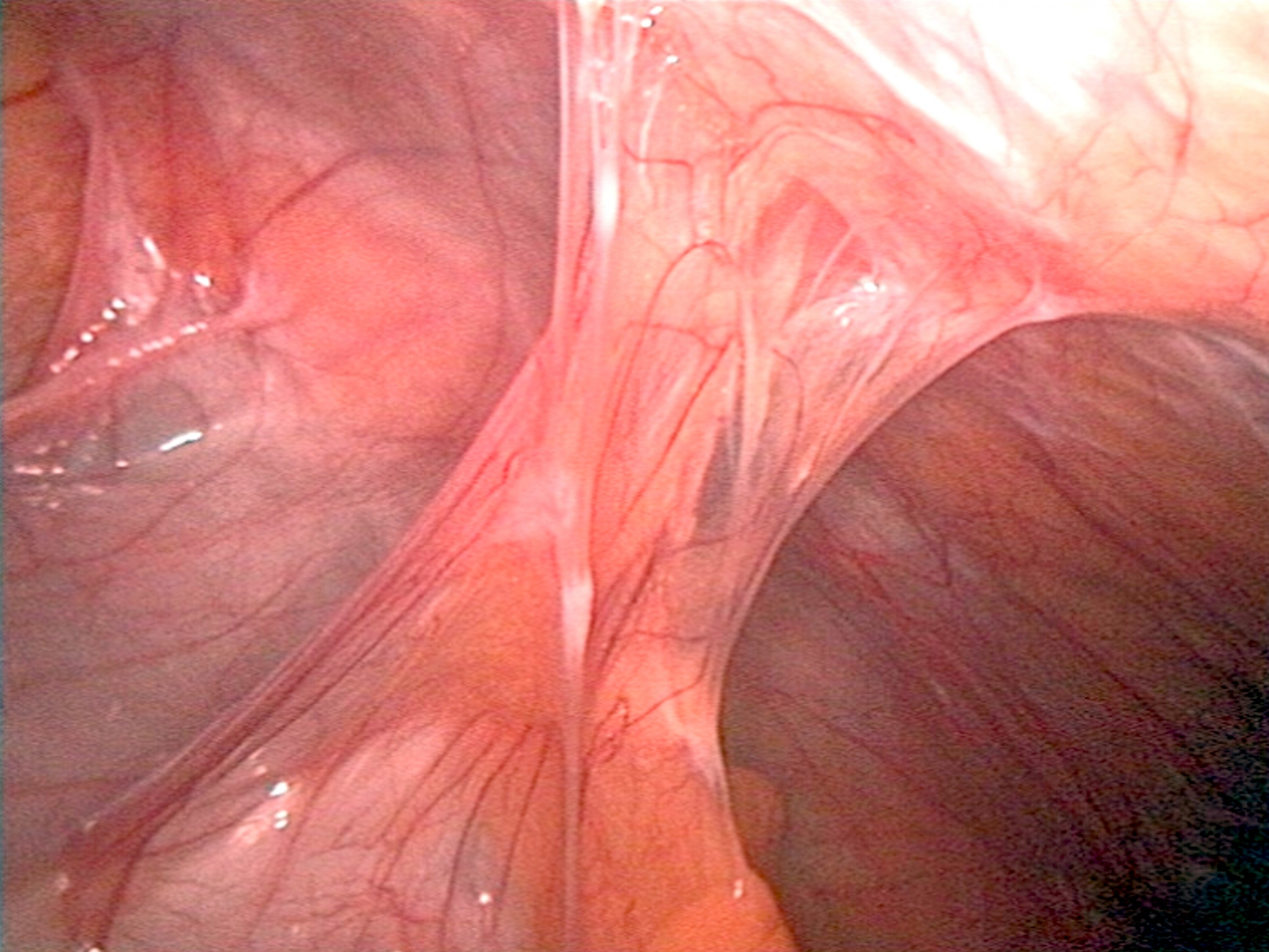 abdominal-adhesions.jpg