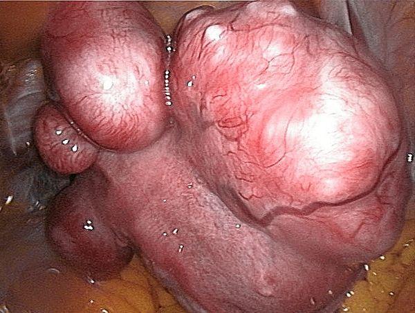 Uterine fibroid tumor - An essential truth for women