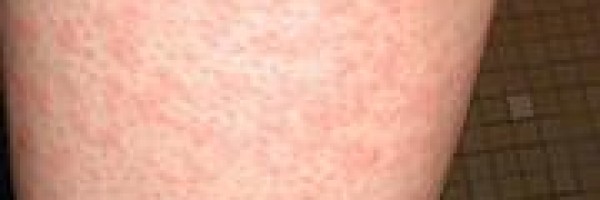 What are hives?