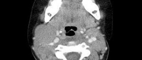 Why is CT scan of abdomen done