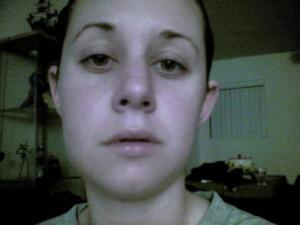 Wisdom Teeth Facial Swelling 75