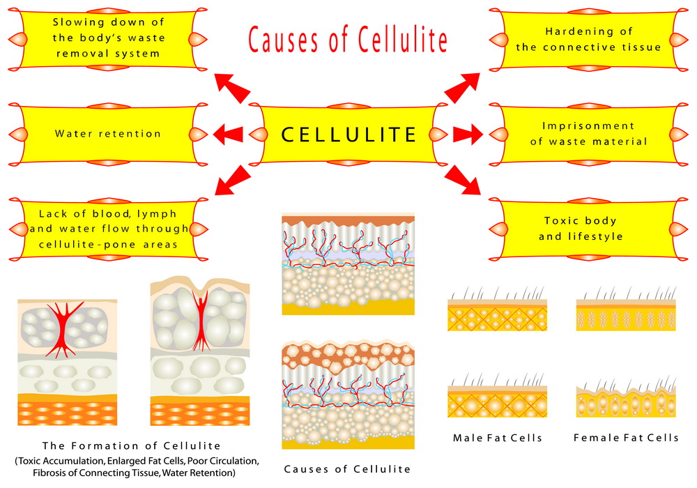 The Most Common Causes Of Annoying Cellulite Beauty Care slideshows 