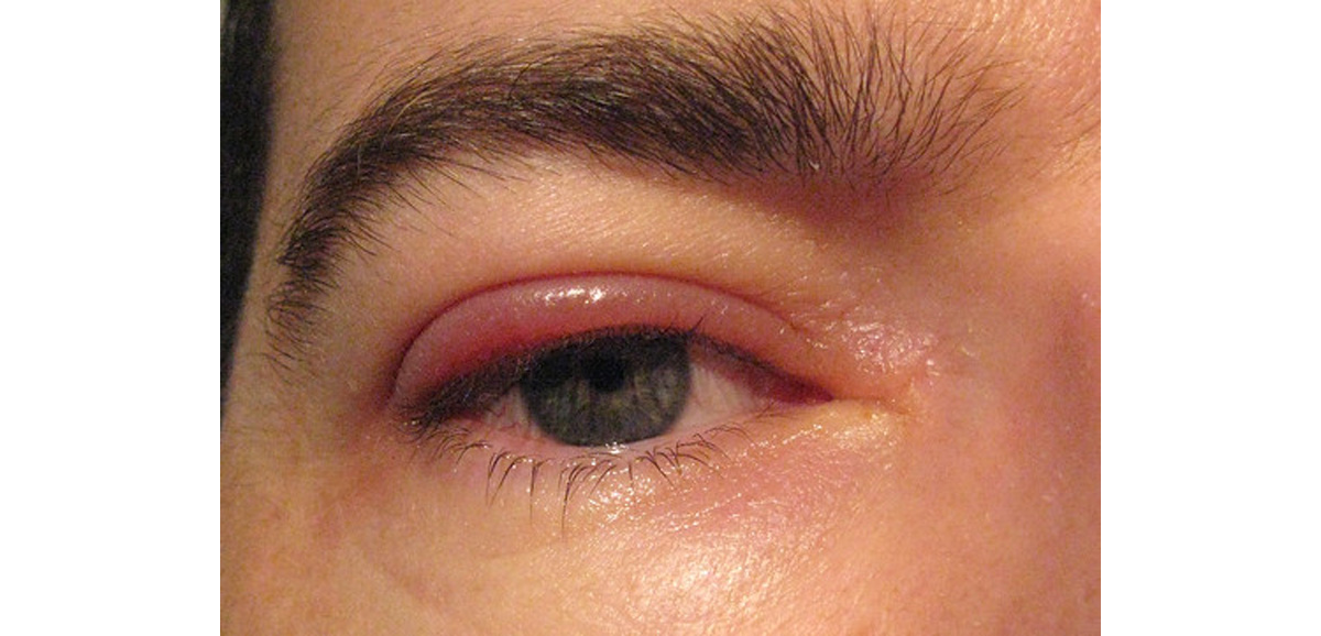 Staphylococcal Blepharitis Treatment | Eye Disorders and Diseases