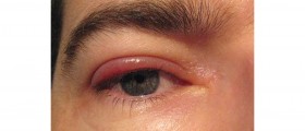 Staphylococcal Blepharitis Treatment